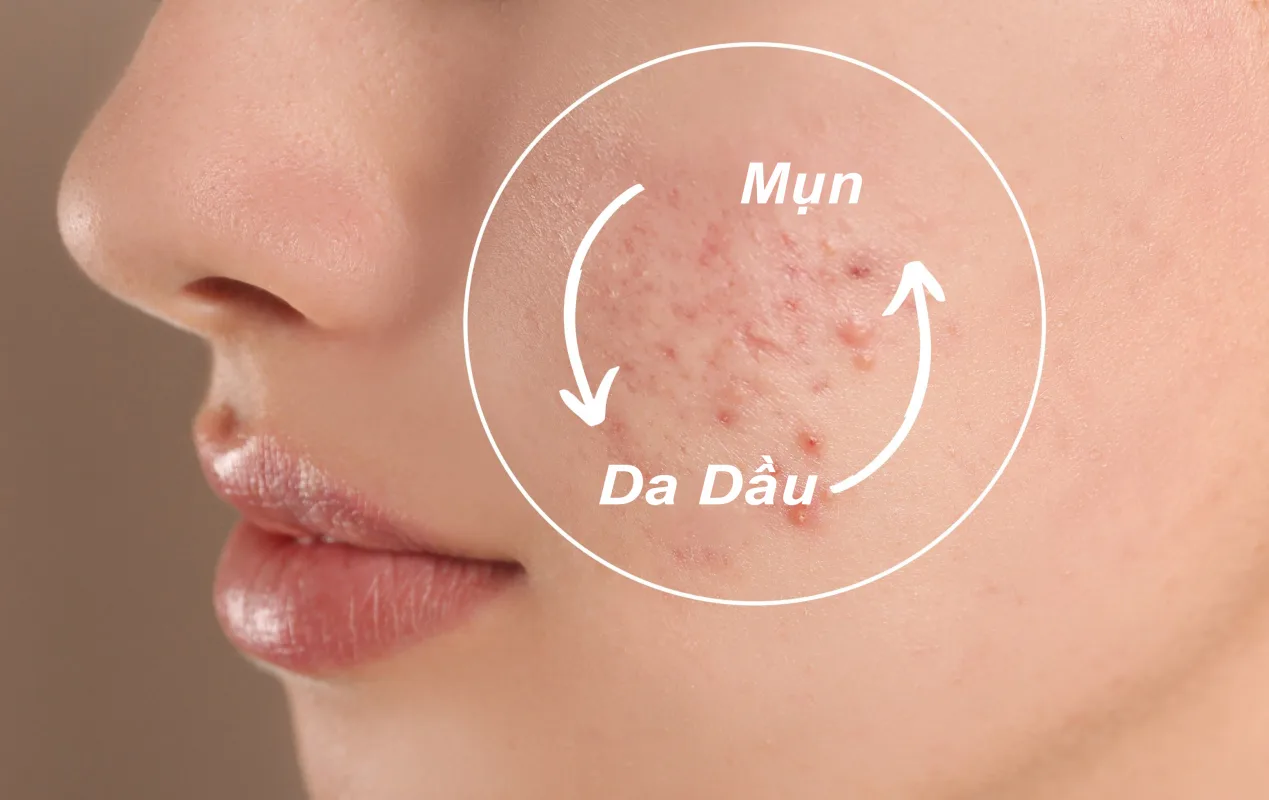Da dầu mụn nên dùng sữa rửa mặt nào