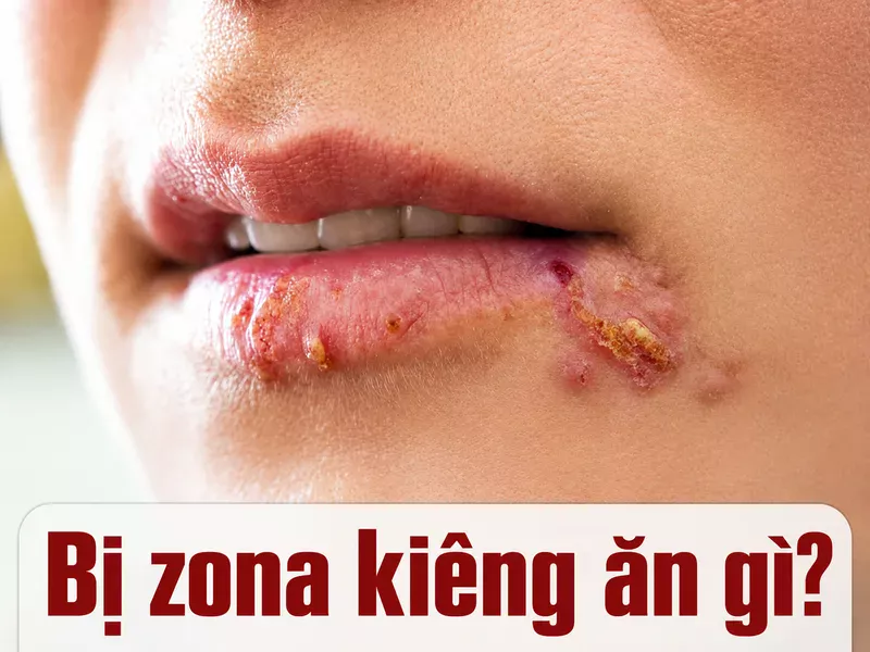 Bị zona kiêng ăn gì để giảm khó chịu và hỗ trợ phục hồi?